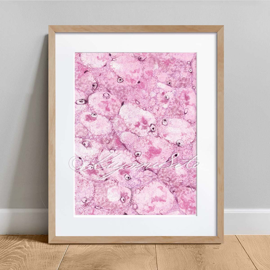 Mallory body Histopathology Art Poster