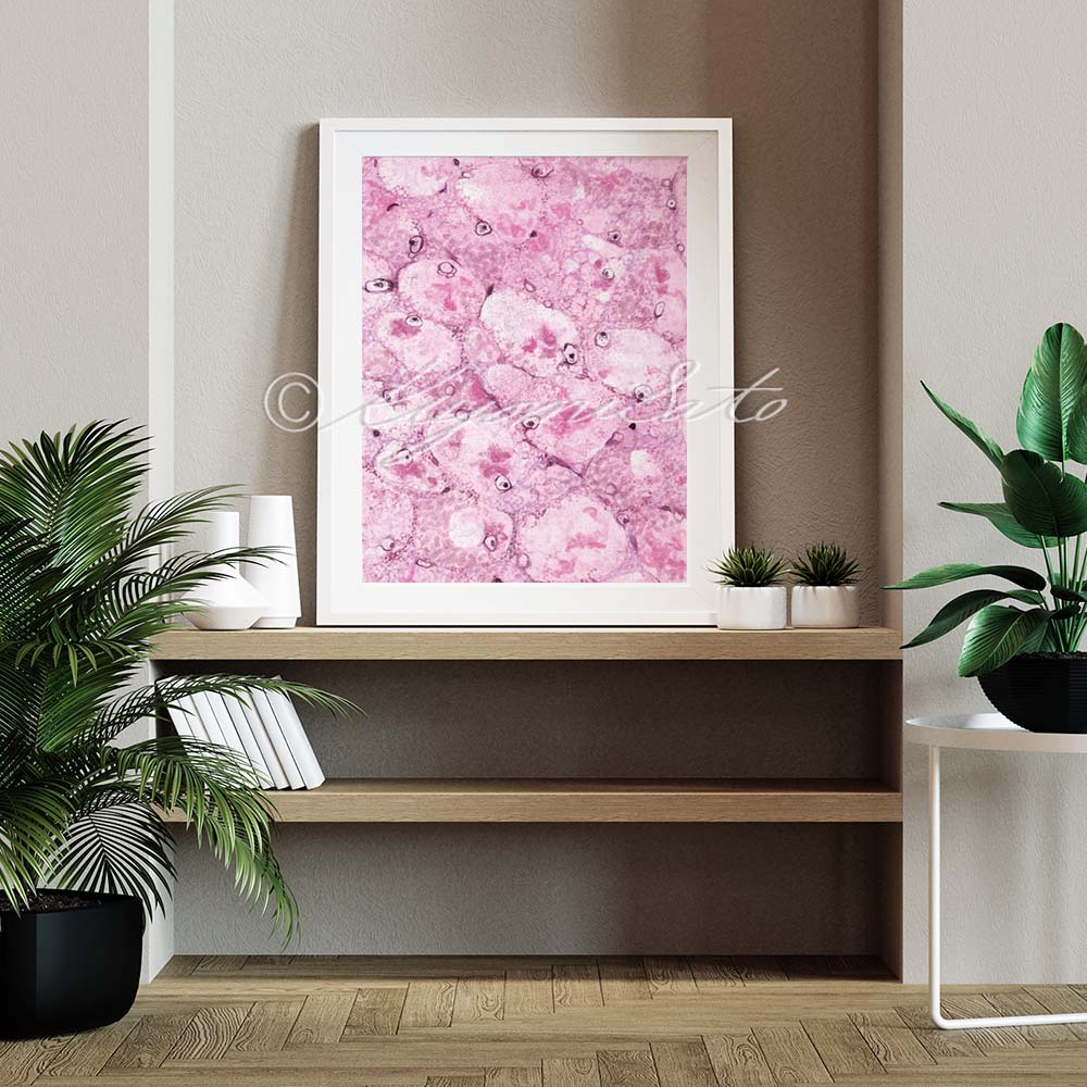 Mallory body Histopathology Art Poster