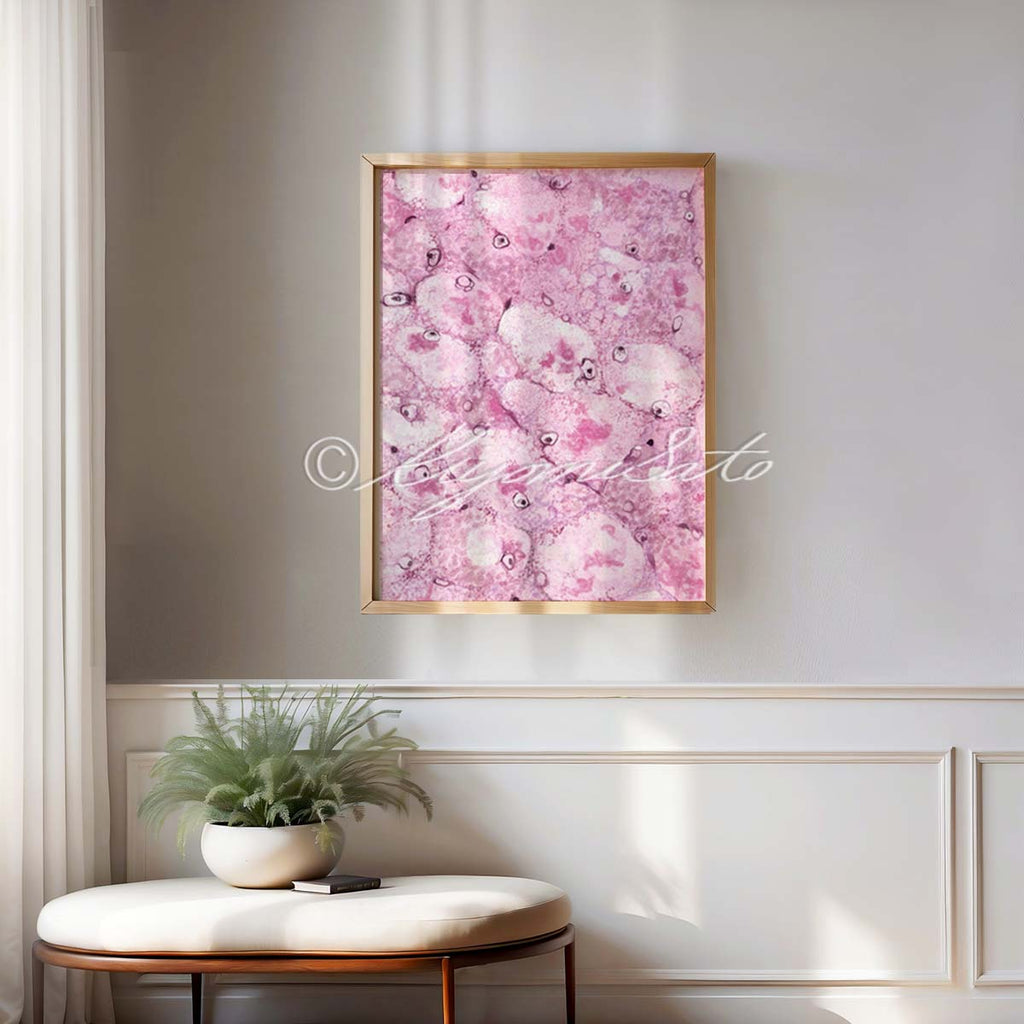 Mallory body Histopathology Art Poster